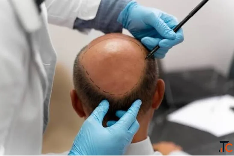 Frame Your Face Again Temple Hair Transplant at Dr. Haror's Wellness