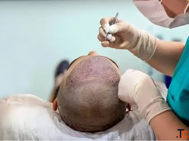 FUE Hair Transplant in Australia Natural Results Transparent Cost