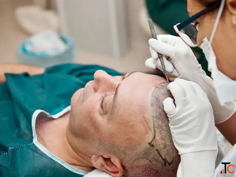 FUE Hair Transplant in Australia Natural Results Transparent Cost