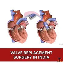 list of Top Valve Replacement Surgeons Delhi