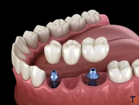 Best Denture Clinic in Chandigarh for Custom-Fit Dentures
