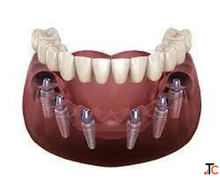 Best Denture Clinic in Chandigarh for Custom-Fit Dentures