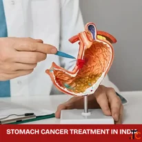 Cost of Stomach Cancer Treatment in India