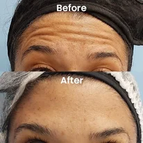Botox Treatment in Delhi