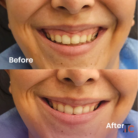 Botox Treatment in Delhi