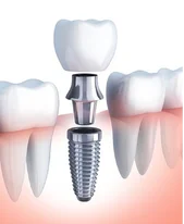 Best Implant Dentist Near Me for a Confident Smile