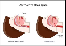 Expert Sleep Apnea Diagnosis and Respiratory Care in Jaipur Rajasthan Asthma Bhawan