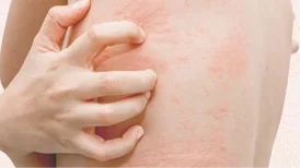 Mast Cell Activation Syndrome