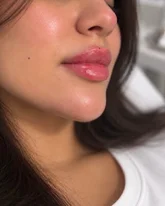 Lip Filler in Toronto for a Personalized Aesthetic Look