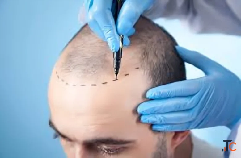 Hair Transplant in Germany Honest Guidance for First-Timers