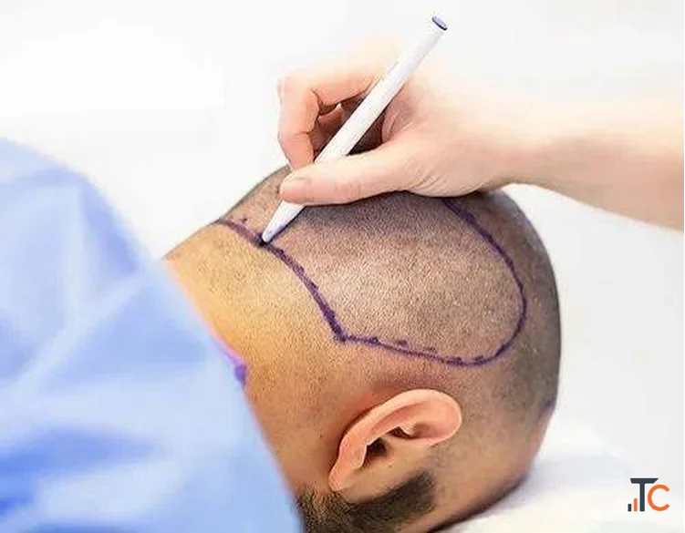 Hair Transplant in Germany Honest Guidance for First-Timers