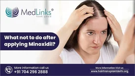 What Not To Do After Applying Minoxidil Medlinks Hair Transplant
