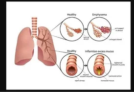 Advanced EBUS Diagnostic Consultation for Chest Conditions in Jaipur Rajasthan Asthma Bhawan