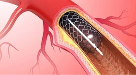 Advanced Heart Care and Angioplasty in Pune