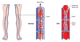 Deep Vein Thrombosis DVT Treatment and Vascular Care in Pune