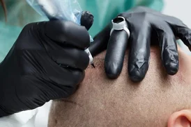 Scalp Micropigmentation in Pune - Eyebrows Lips Scalp Clinic