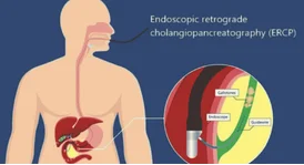 Esophageal Motility Disorder Treatment in Delhi Expert Care