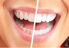Teeth Whitening in Pune Procedures Results and Aftercare