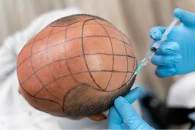 Hair Transplant Service Bhubaneswar